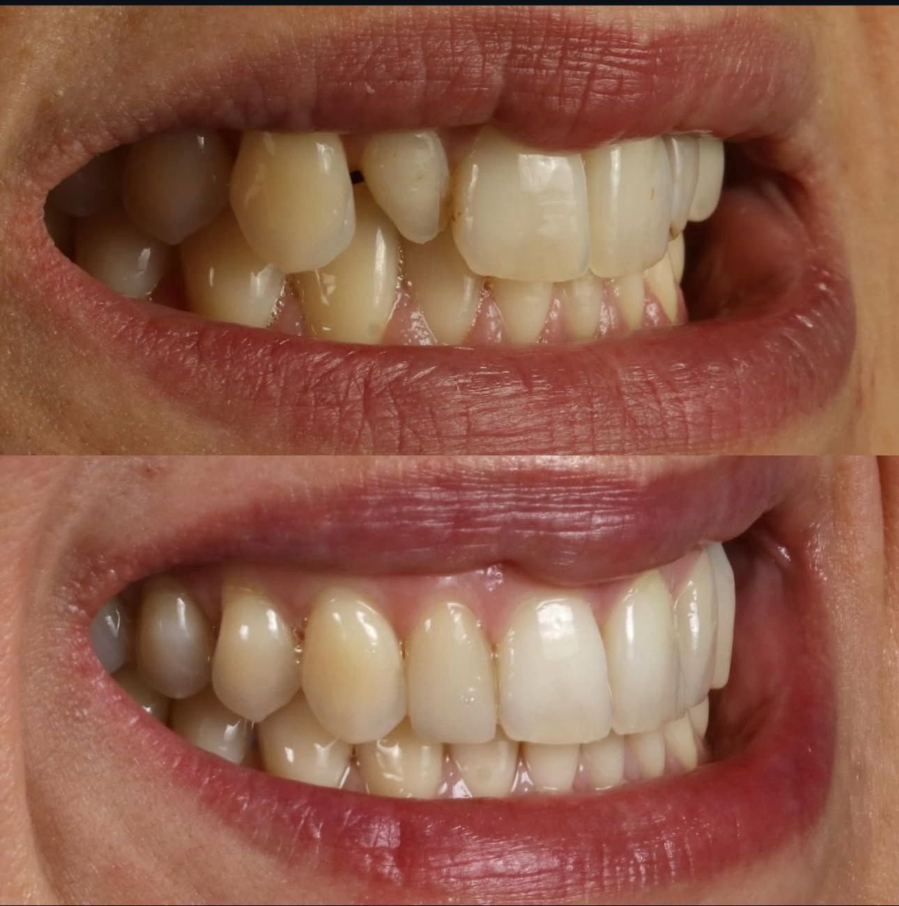 Carillas dentales - Caso 4